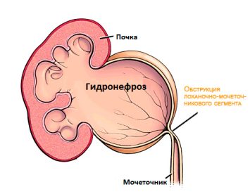 Чем и как лечится гидронефроз правой почки