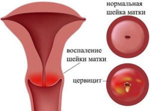 лечить кровь после мочеиспускания 