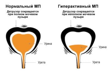 Как лечится гиперактивный мочевой пузырь у мужчин