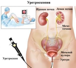 Как можно эффективно лечить камни в мочеточнике у мужчин