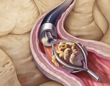 Как можно эффективно вывести камень из мочеточника