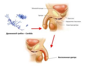 Симптомы и лечение кандидозного уретрита