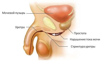 Симптомы и лечение острого уретрита у мужчин